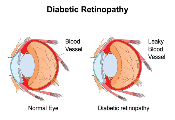 diabetic