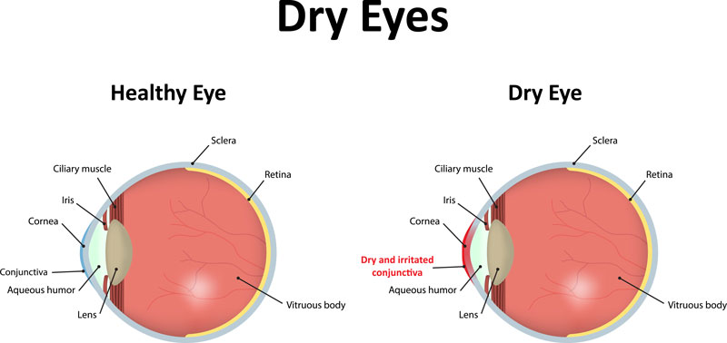 dry-eyes