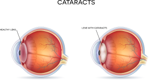 Cataract