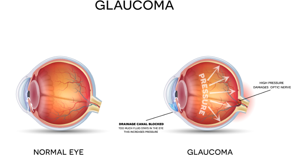 glaucoma